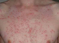 Ürtiker Çeşitleri Nelerdir ve Bulaşıcı mıdır?