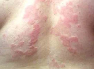 Alerjik Ürtiker Belirtileri ve Tedavisi