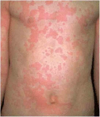 Çocuklarda Ürtiker Belirtileri ve Tedavisi