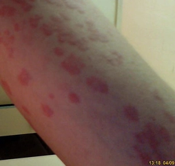 İdiyopatik Ürtiker Belirtileri ve Tedavisi